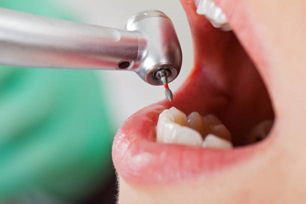 Best Emergency Dentist for Lost Fillings or Crowns in Fairfield, IL